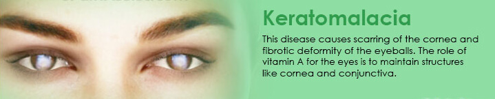keratomalacia